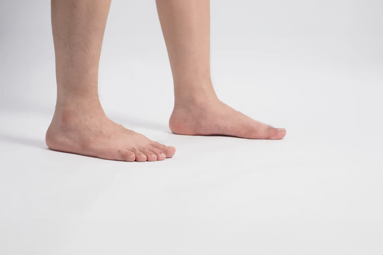 Flat foot: origins, distinctive characteristics, and complications FOOT CARE TIPS AND ADVICE FLAT FOOT ORIGINS DISTINCTIVE CHARACTERISTICS AND COMPLICATIONS