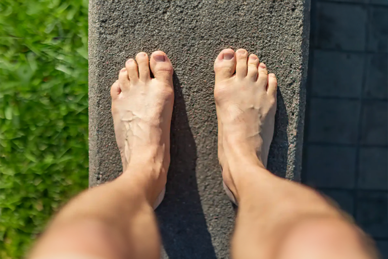 Wide foot: origins, characteristic signs, and complications FOOT CARE TIPS AND ADVICE WIDE FOOT ORIGINS CHARACTERISTIC SIGNS AND COMPLICATIONS